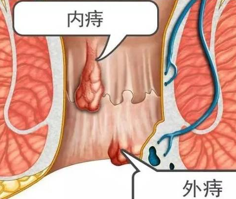 用烟放在痔疮上管用吗_用香烟塞肛门治痔疮_香烟治疗痔疮